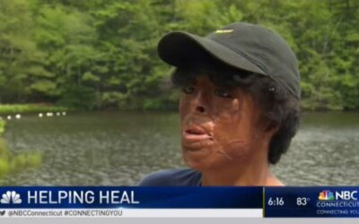 Union Camp Provides Safe Place for Burn Victims