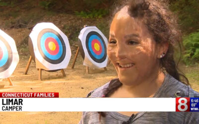 Union camp allows young burn survivors to be kids