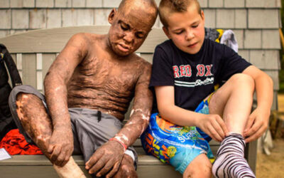 Camp Offers Haven For Young Fire Victims: They’re Not ‘The Burned Kid’ Here